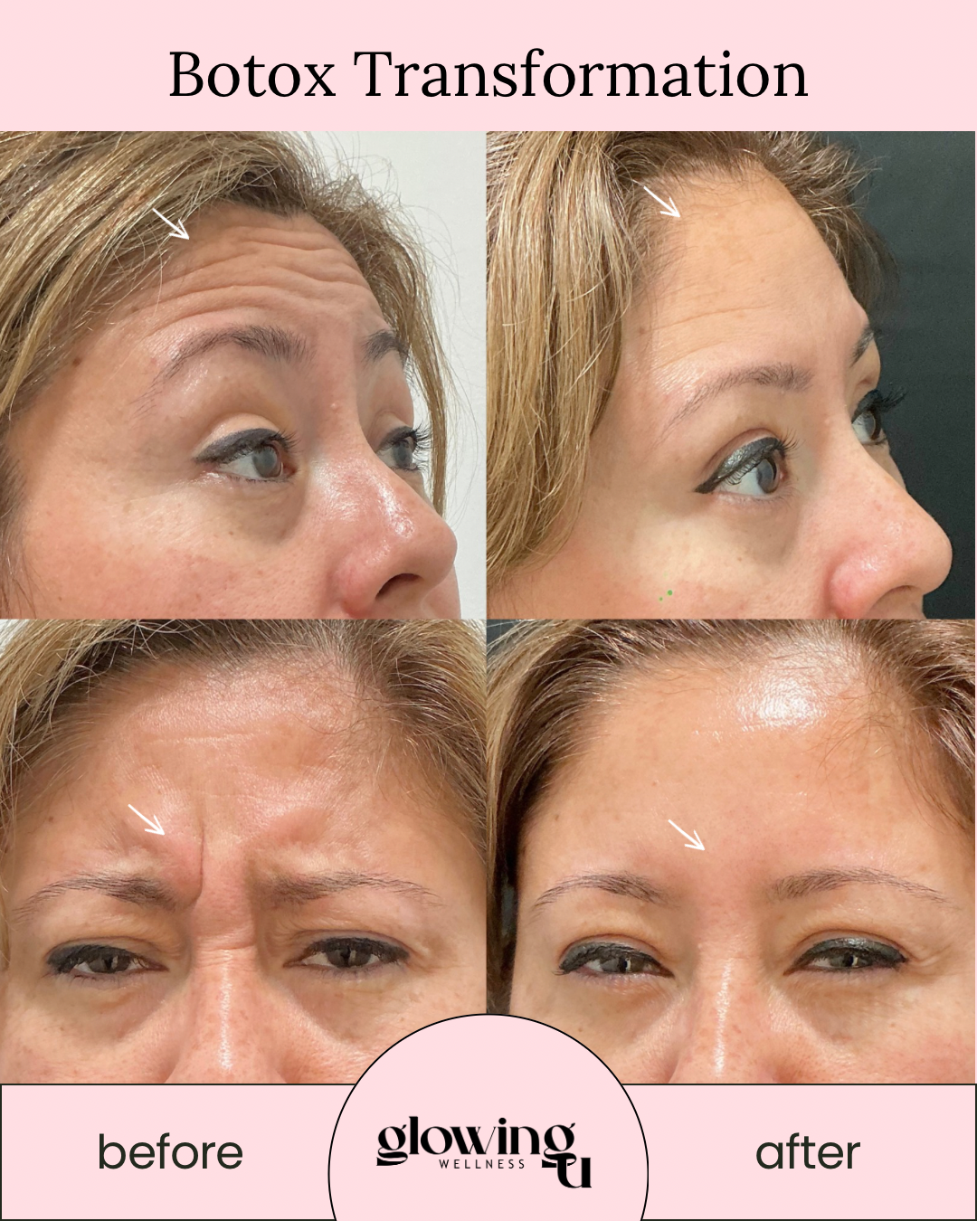 Collage showing before and after pictures of Botox treatment. The top images focus on forehead lines, which are reduced in the after image, and the bottom images display frown lines, which are diminished post-treatment.