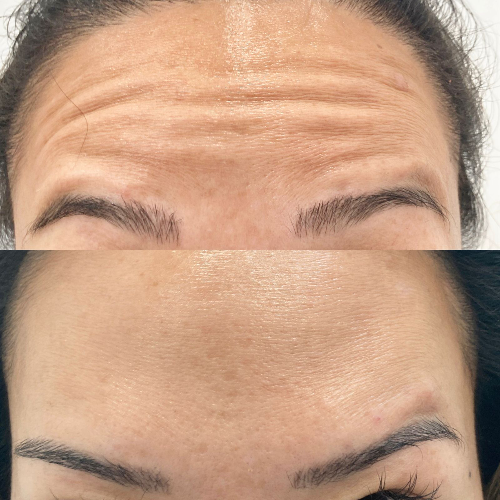 Close-up of a person's forehead showing before and after skincare treatment, with visible reduction in wrinkles and smoother skin
