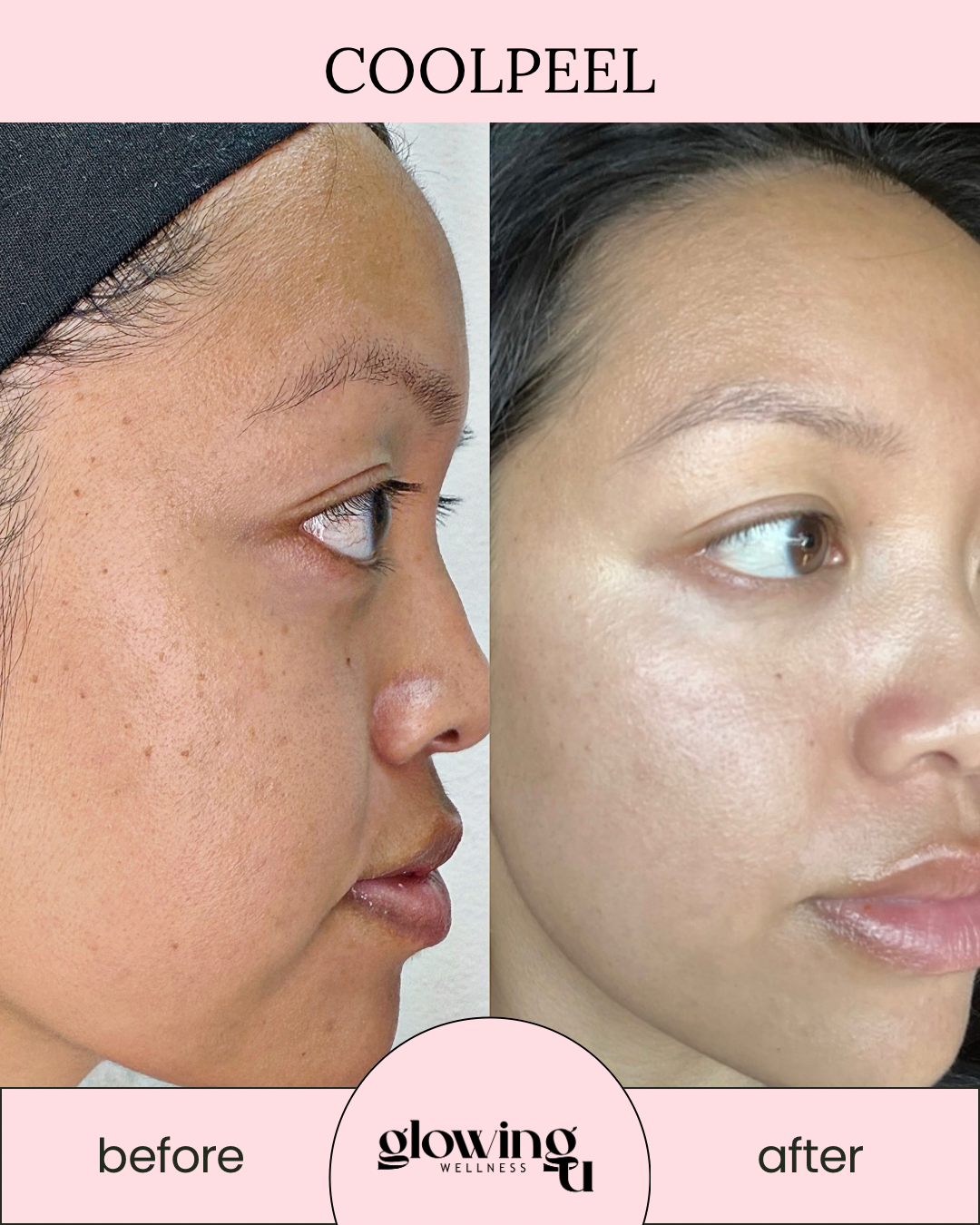 Side-by-side comparison of a woman's face showing skin improvement. The left side labeled "before" with textured skin, after labeled "after" with smoother skin. The background header reads "COOLPEEL" and the logo at the bottom says "glowing WELLNESS."
