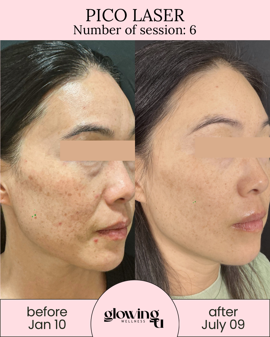 Side-by-side photos showing a woman's face before and after Pico Laser treatment. The before image, taken on January 10, shows she had significant acne scars and uneven skin tone. The after image, from July 9, shows smoother skin with reduced scars and even skin tone. The photos are part of a skincare promotion by Glowing Wellness.