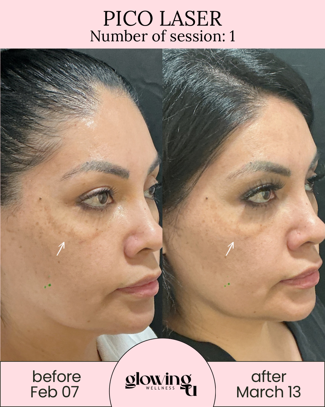 Side-by-side comparison of a woman's face before and after Pico Laser treatment, showing reduction in facial pigmentation and spots, with dates February 7 and March 13 at Glowing Wellness.