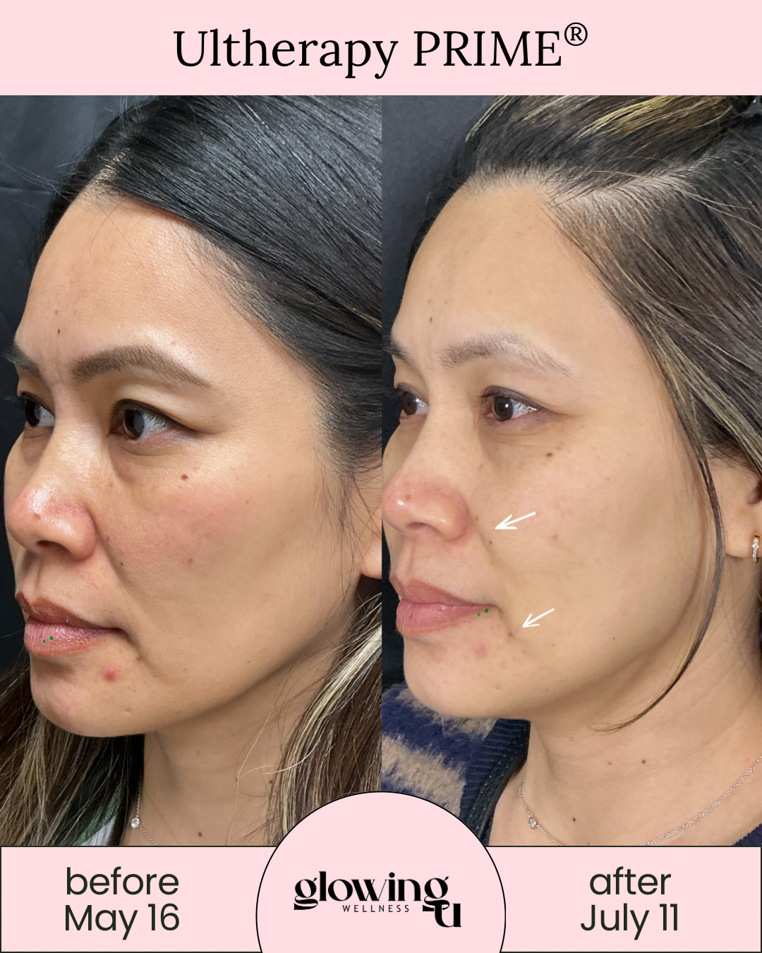 Side-by-side comparison of a woman's face before and after Ultherapy PRIME treatment. The before side shows skin with blemishes and uneven texture, while the after side shows clearer, smoother skin with fewer blemishes, with some highlighted areas indicating improvements.