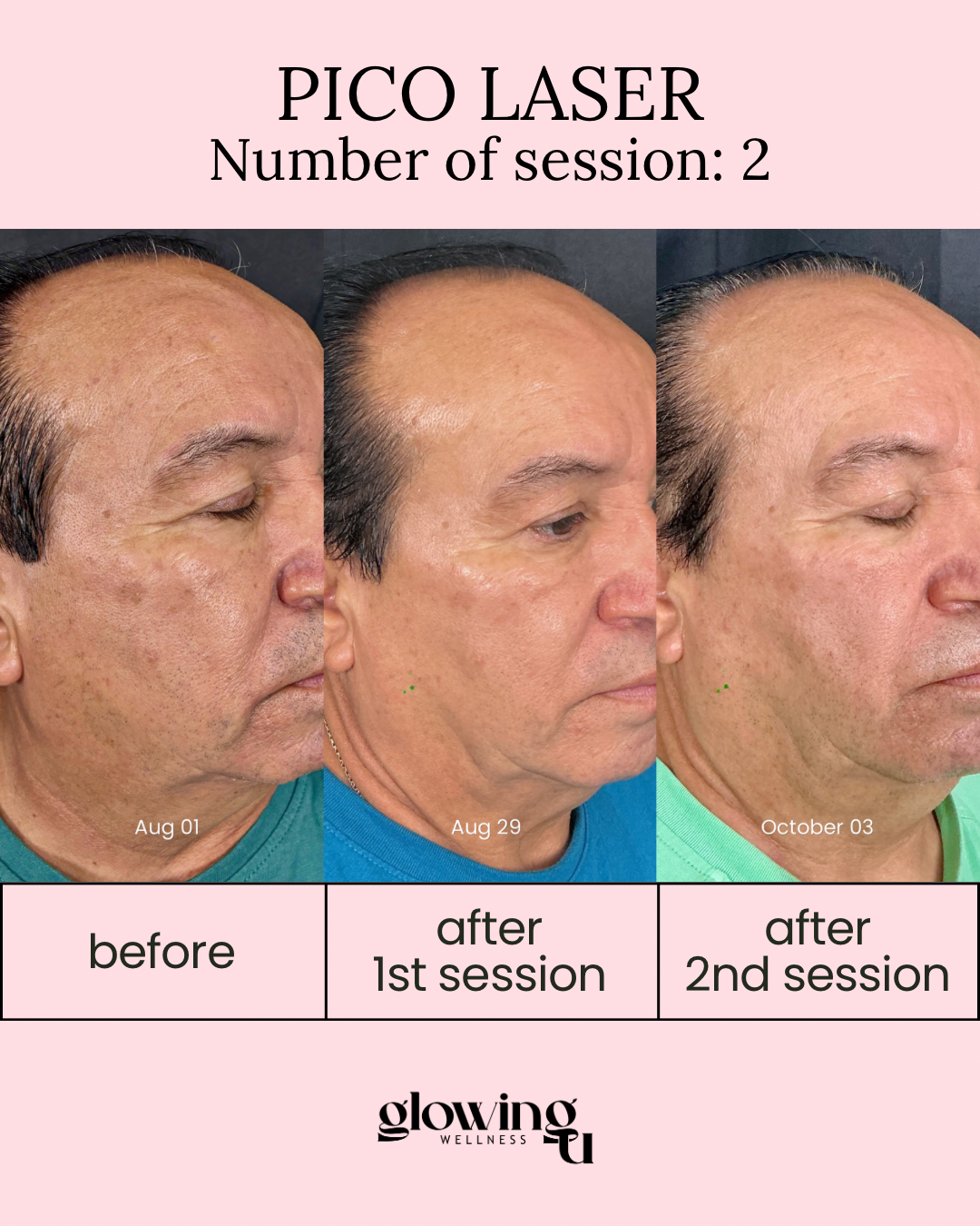 A side-by-side comparison of a man's face showing the results of Pico Laser skin treatment over three months. The first image is before treatment, the second after the first session in August, and the third after the second session in October. The background is pink with text indicating the dates and treatment details.
