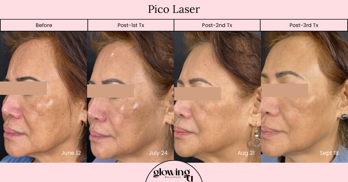 A series of four side-profile photos showing a woman's face before and after Pico Laser treatment over a period of three months, with dates June 12, July 24, August 21, and September 18, and the logo of Glow Inc Wellness at the bottom.
