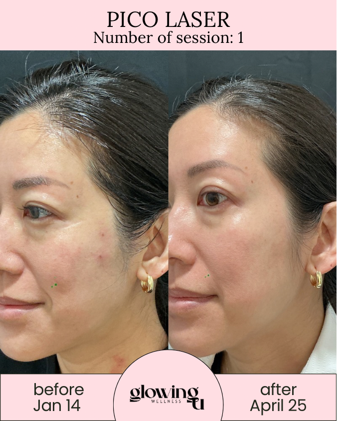 Side-by-side photos of a woman's face showing skin improvement after Pico Laser treatment. The left photo is labeled 'before Jan 14' and the right 'after April 25,' with the title 'Pico Laser' and 'Number of session: 1' at the top. The logo 'glowing WELLNESS' appears at the bottom center.