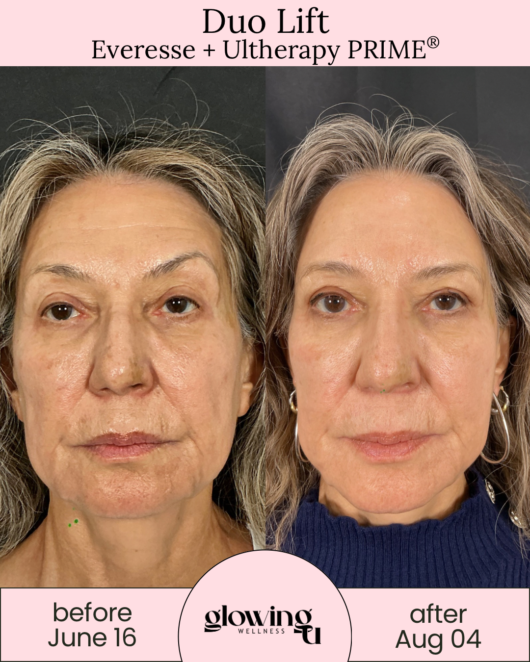 Side-by-side comparison of a woman's face before and after skincare treatment, showing improvements in skin texture and appearance. The before photo is dated June 16, and the after photo is dated August 4, with the branding 'Duo Lift Everesse + Ultherapy PRIME' and 'Glowing Wellness' at the bottom.