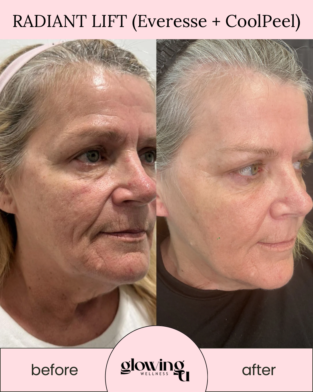 Before and after side-by-side photos showing a woman's face, demonstrating facial skin improvements after a radiance lift treatment with Everesse and CoolPeel, by Glowing U Wellness, with the label 'RADIANT LIFT (Everesse + CoolPeel)'