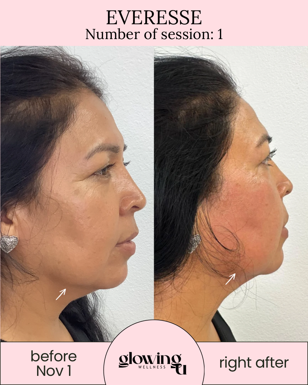 Side-by-side comparison photos of a woman's face before and after a skincare or cosmetic treatment, showing improvement in skin texture and tone, with arrows pointing to her jawline on both images. from Glowing U Wellness