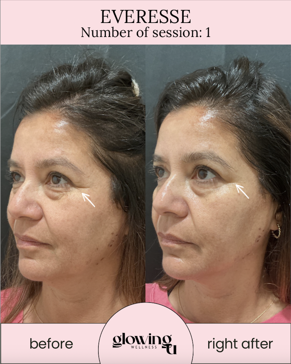 Side-by-side comparison of a woman's face before and after a skincare treatment, highlighting under-eye area improvement with arrows pointing to it.