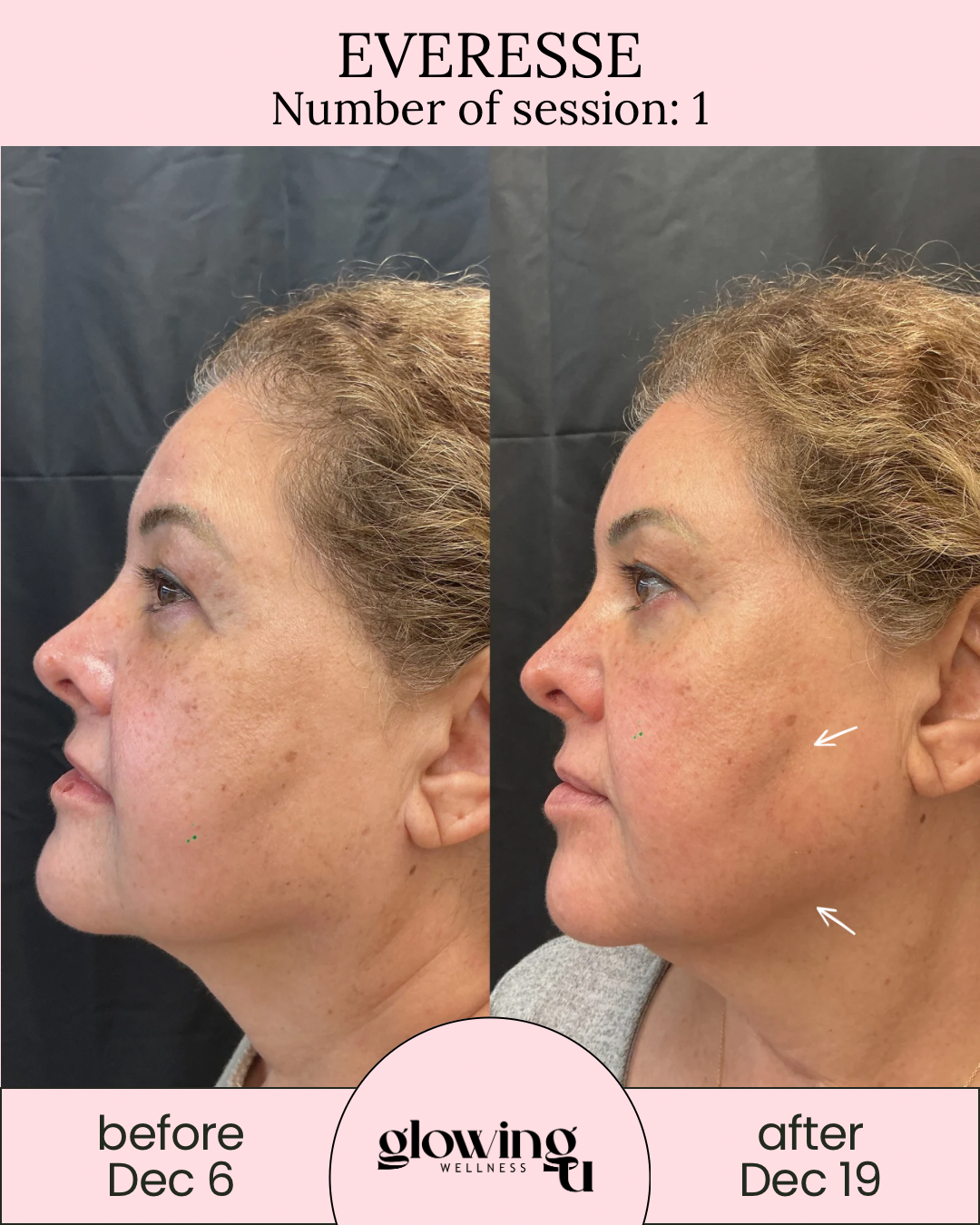Side-by-side comparison of a woman's face before and after skincare treatment, showing reduced hyperpigmentation and smoother skin. The before image is dated December 6, and the after image is dated December 19, with results from Glowing Wellness.