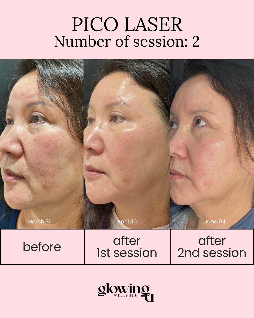 Before and after photos showing the skin improvements of a woman over three months after Pico Laser treatments, with labels for March 31, April 30, and June 04, indicating the progression after the 1st and 2nd sessions at Glowing Wellness.