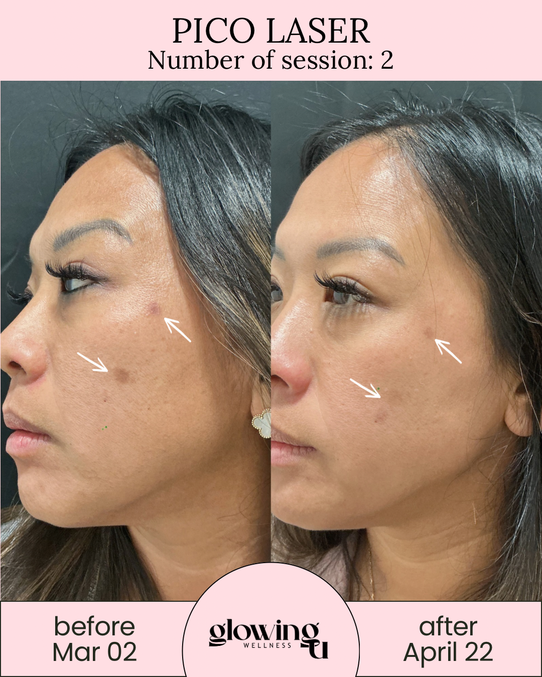 Side-by-side comparison of a woman's face before and after a Pico Laser treatment, showing improved skin texture and reduced pigmentation.