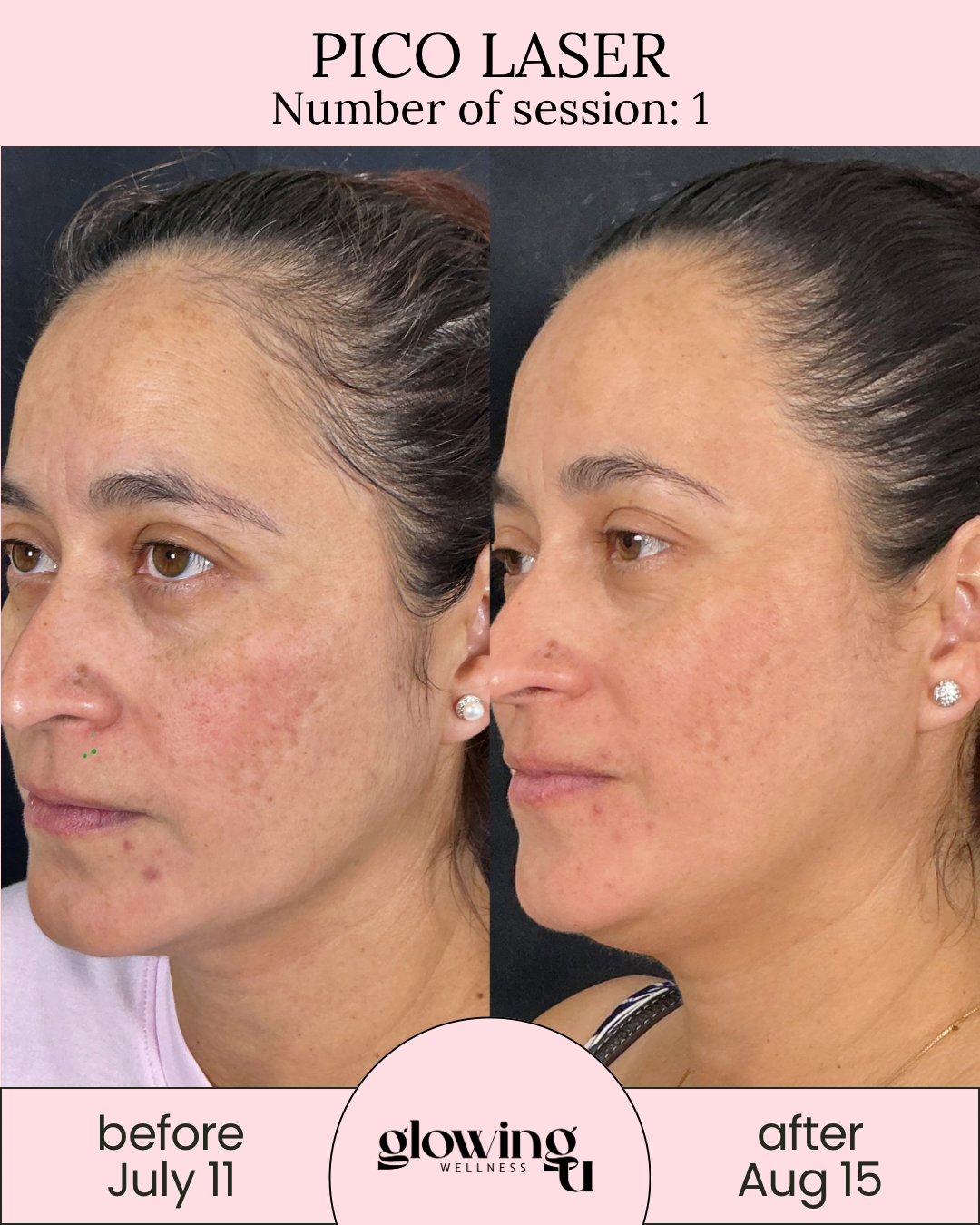 Side-by-side comparison of a woman's face before and after Pico Laser treatment, showing improved skin texture and reduced pigmentation, with the before photo dated July 11 and the after photo dated August 15, at Glowing Wellness.
