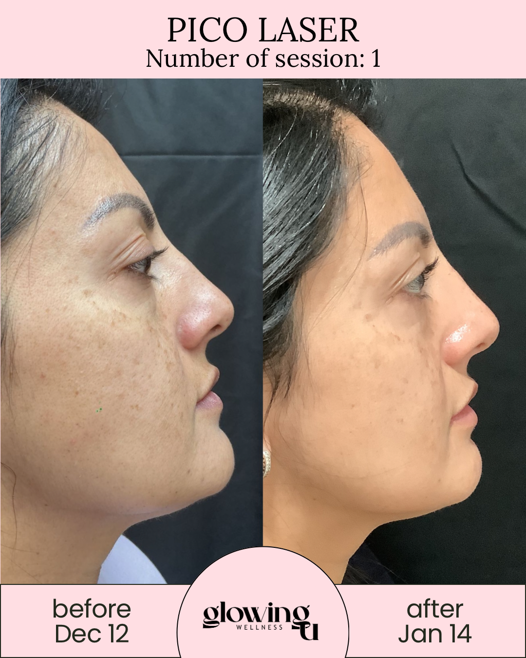 Side-by-side comparison of a woman's face before and after a skin treatment, with the before photo taken on December 12 and the after on January 14, showing clearer and smoother skin.