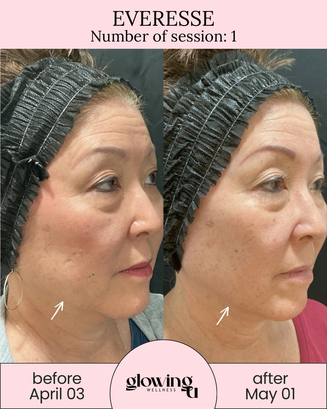 Side-by-side comparison of a woman's face before and after skincare treatment, with visible improvements in skin texture and pigmentation, labeled 'before April 03' and 'after May 01'.
