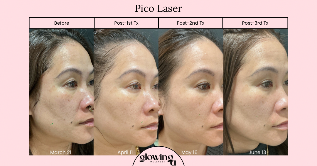 Progress photos of a woman showing skin improvement over time after Pico Laser treatments, labeled 'Before', 'Post-1st Tx', 'Post-2nd Tx', and 'Post-3rd Tx', with dates March 21, April 11, May 16, and June 13.