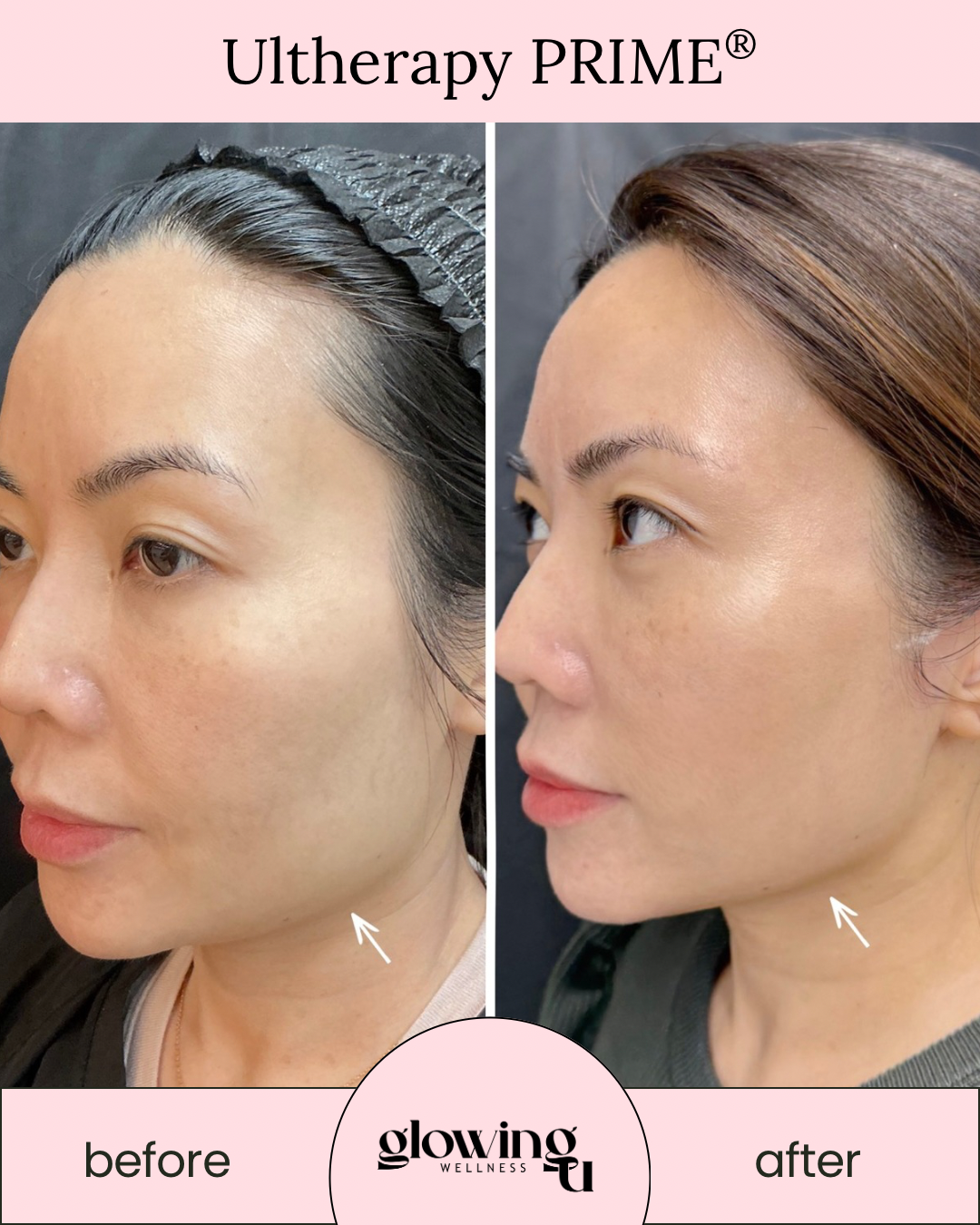 before after pic of Ultherapy Prime at Glowing U Wellness in Torrance