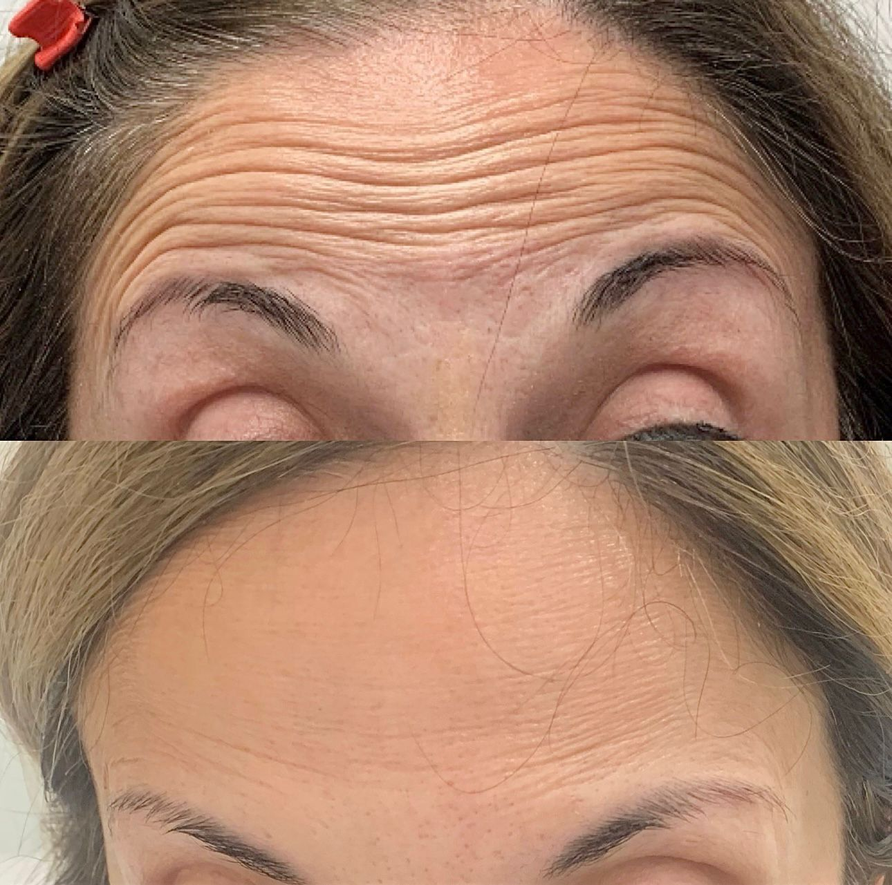 Close-up of a woman's forehead before and after a cosmetic treatment, showing reduced wrinkles and smoother skin.