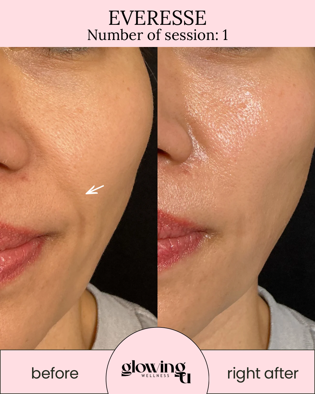 Comparison of a person's cheek before and after a skincare session, showing smoother, more radiant skin after treatment at Glowing Wellness.