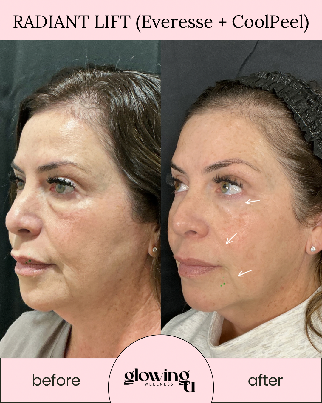 Side-by-side comparison of a woman's face before and after Radiant Lift treatment with Everesse and CoolPeel, showing facial skin improvements, with labels 'before' and 'after', and the logo 'glowing wellness' at the bottom.