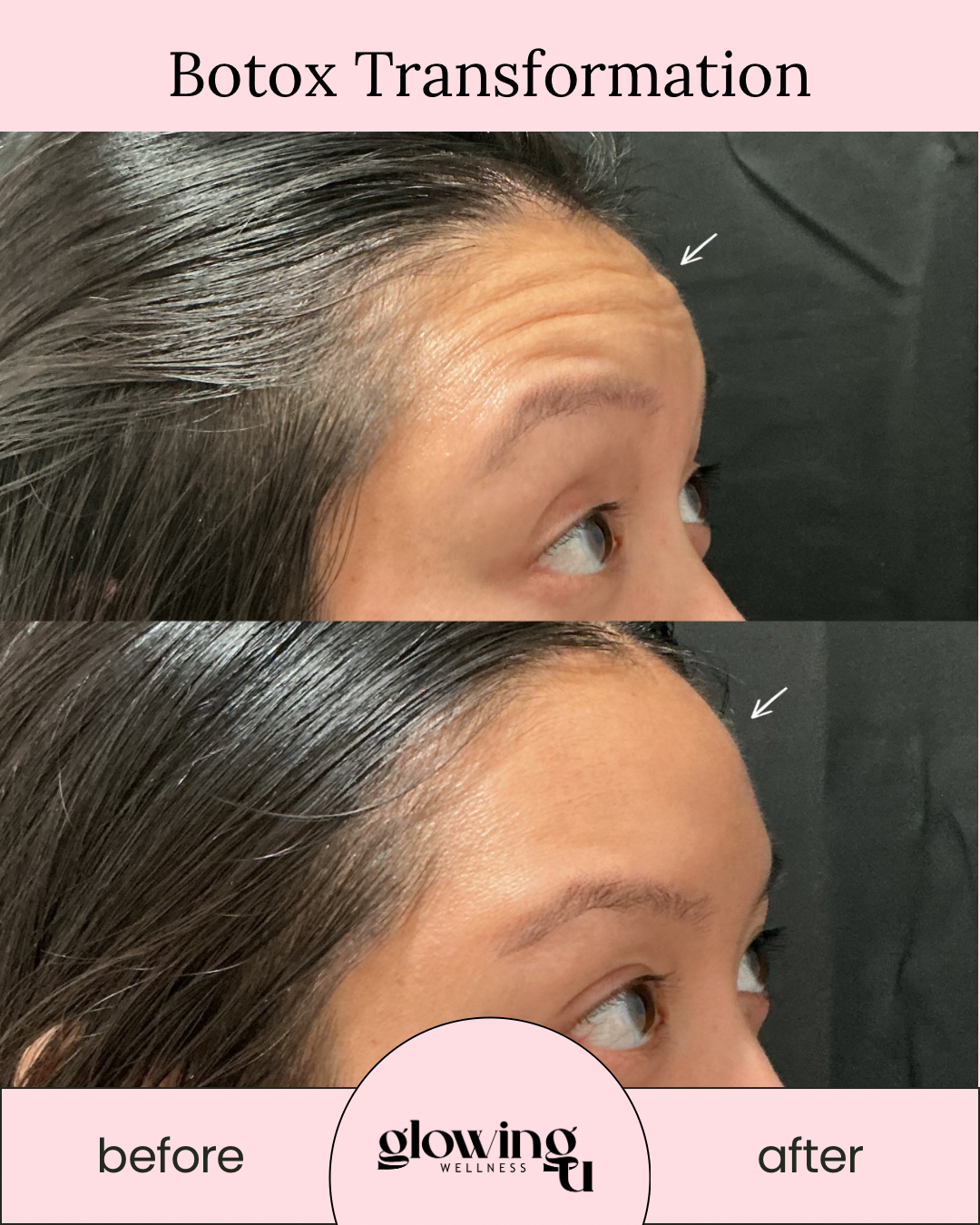 Comparison of a woman's forehead showing wrinkles before and after Botox treatment, with labels 'before' and 'after' and a pink banner that says 'Botox Transformation' at the top, and the logo 'glowing wellness' at the bottom.