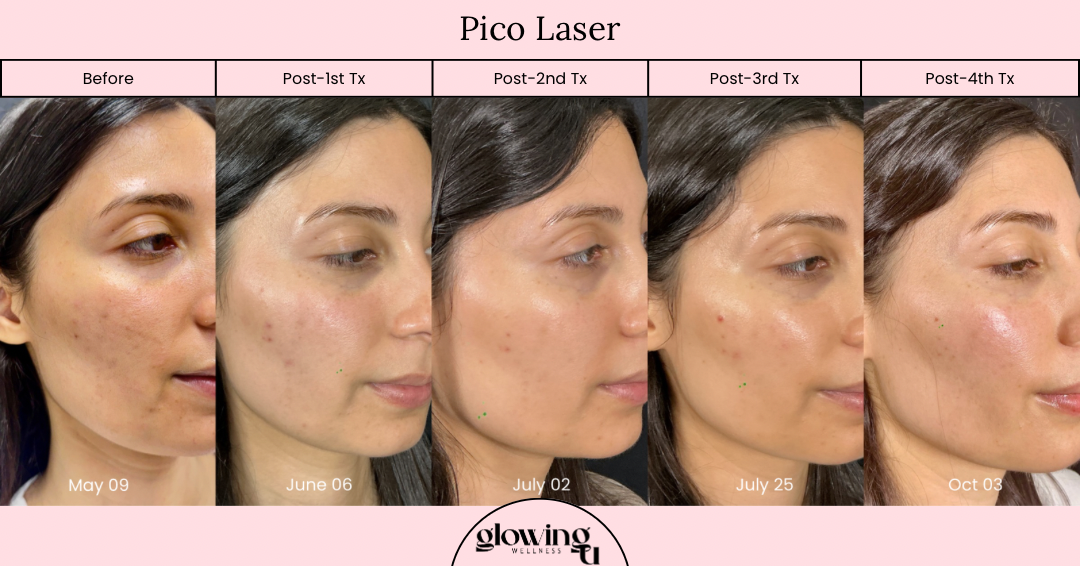 Progress photos of a woman's face showing skin improvements after Pico Laser treatments over several months, from May to October, with labels indicating treatment timelines.