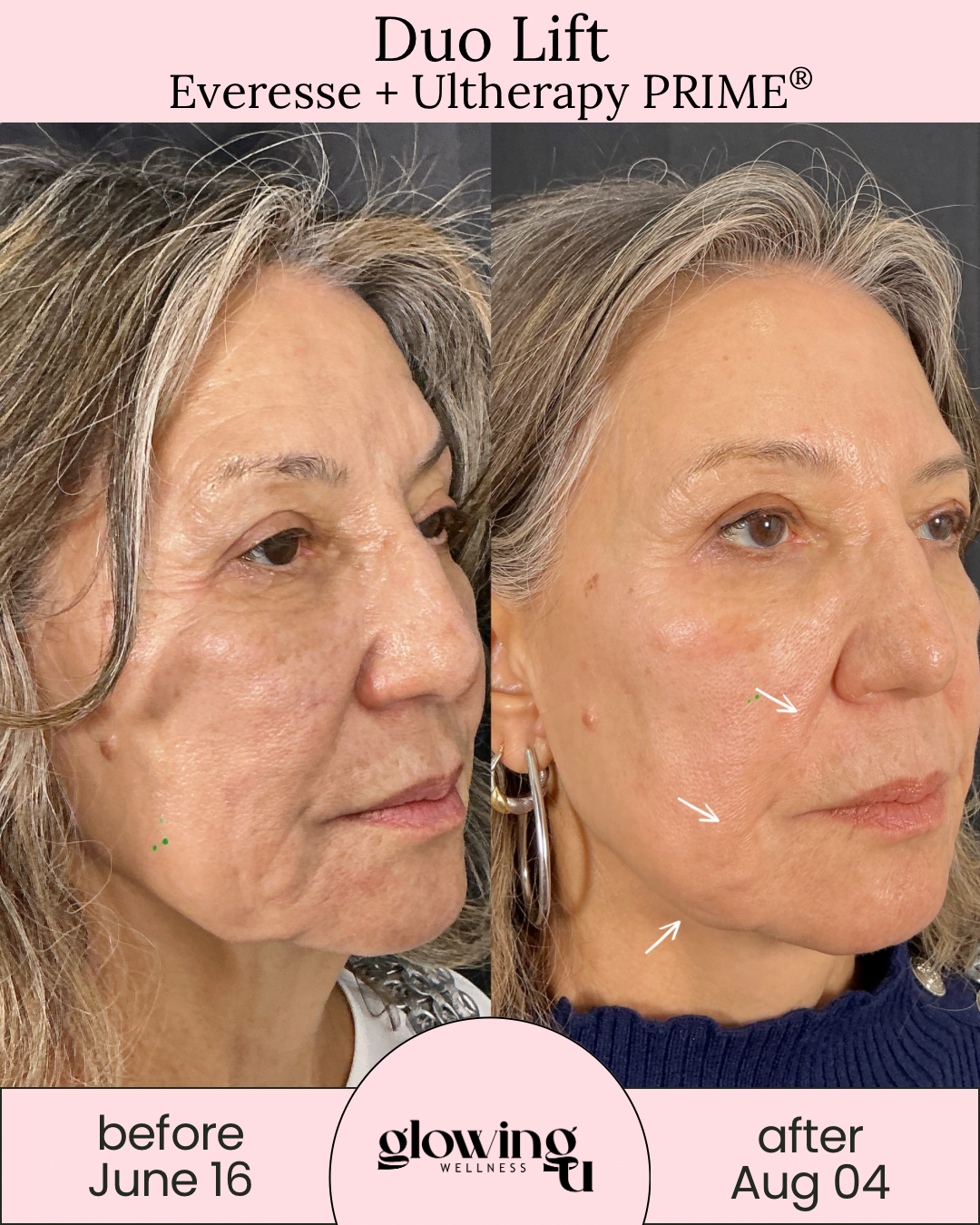 Side-by-side comparison of a woman's face showing skin improvement before June 16 and after August 4, indicating results from Duo Lift, Everesse, and Ultherapy PRIME treatments, with visible reduction in wrinkles and skin tightening.
