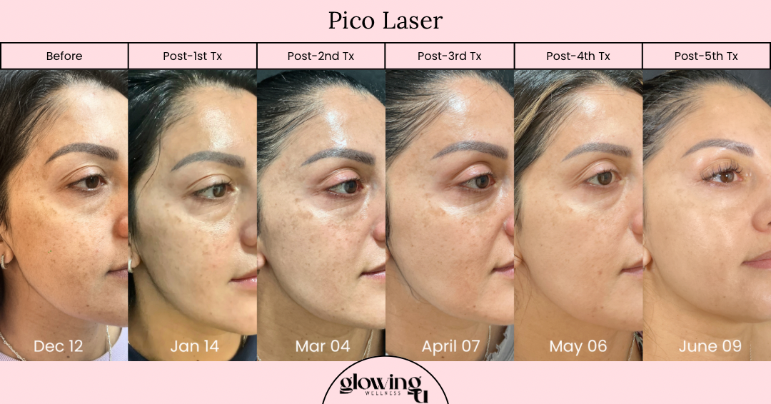 Progress photos showing a woman's face over time, labeled from December 12 to June 9, demonstrating skin improvement after Pico Laser treatments. The images are arranged in chronological order from left to right, with labels indicating pre-treatment and post-treatment months.