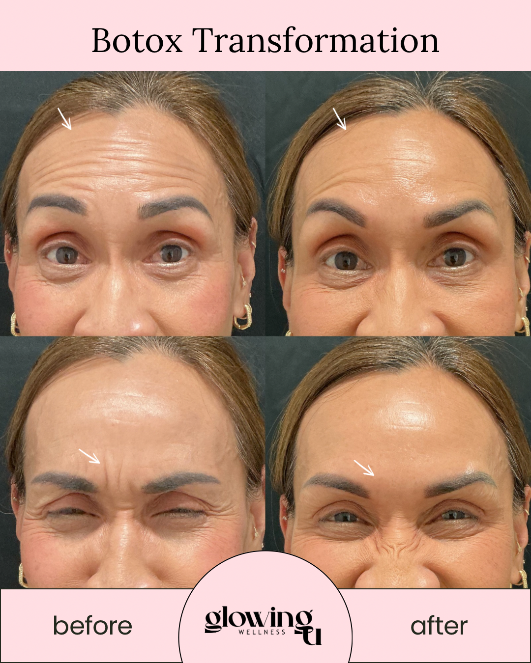 Comparison of a woman's face before and after Botox injection treatment, showing reduced forehead wrinkles and crow's feet.