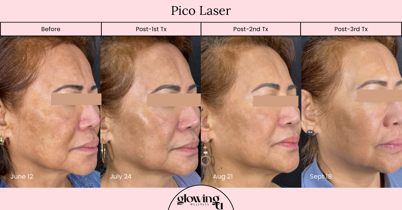 Progress photos of a woman's face taken before and after Pico Laser treatments on June 12, July 24, August 21, and September 18, showing reduction in skin pigmentation and improvement in skin texture.
