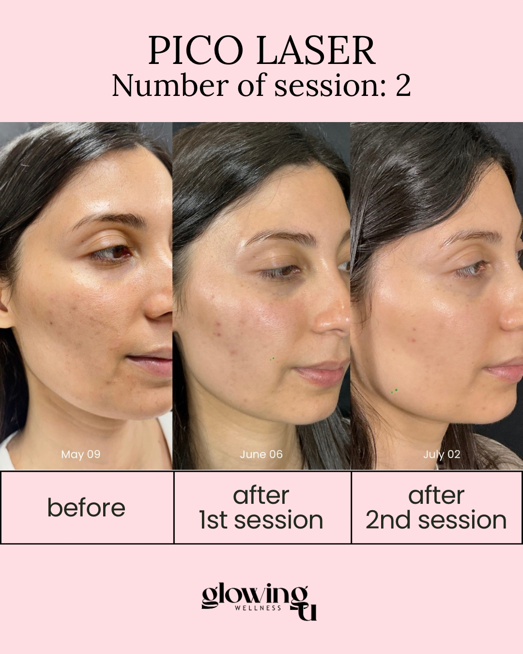 Progress photos of a woman showing improvements in skin condition over three dates: May 09, June 06, and July 02, after undergoing Pico Laser treatments, with before, after first session, and after second session captions.