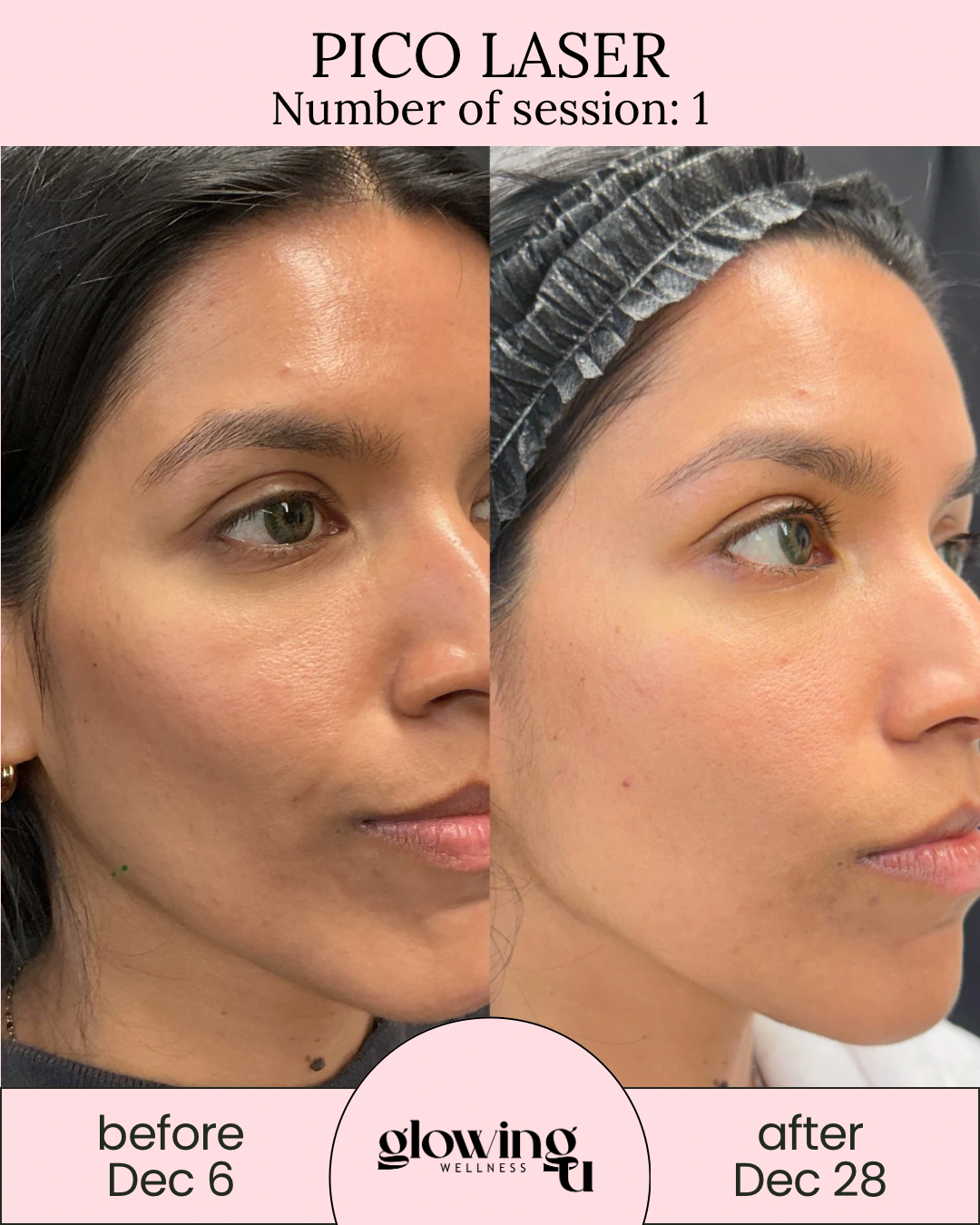 Side-by-side comparison of a woman's face showing before and after laser treatment, with text indicating 'PICO LASER' session 1, before on December 6 and after on December 28. from Glowing U Wellness