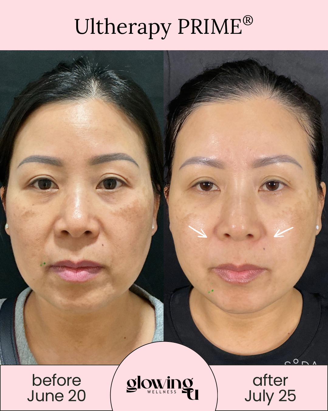 Side-by-side comparison photo of a woman showing skin improvement from Ultherapy treatment, with the left labeled 'before June 20' and the right labeled 'after July 25', with a pink banner at the top reading 'Ultherapy PRIME®' and a circular logo for Glowing Wellness in the center.