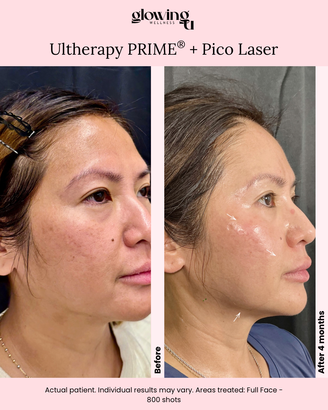 Comparison of a woman's face before and after 4 months of Ultherapy PRIME and Pico Laser treatments, showing improved skin texture and reduced wrinkles on the face.