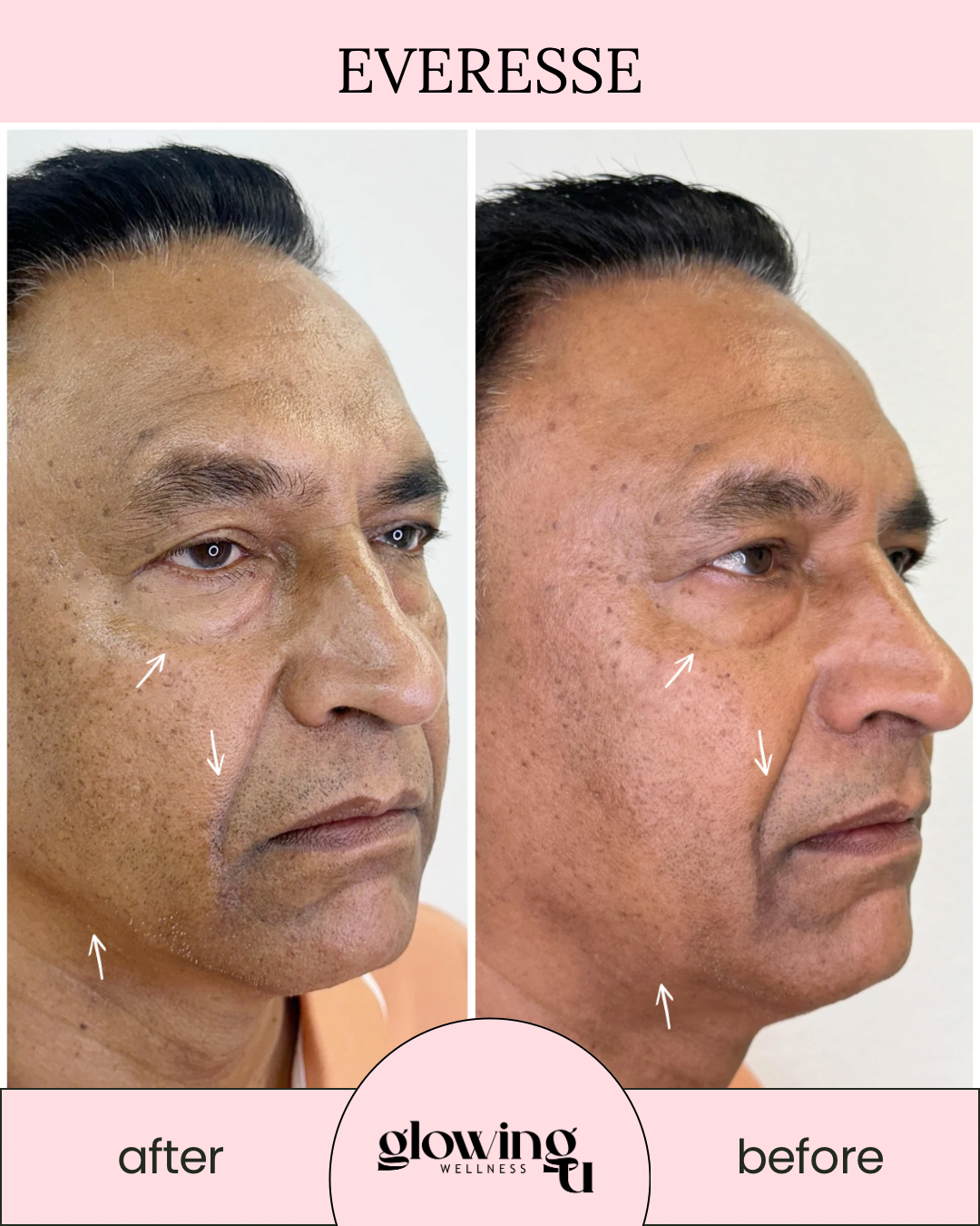 Side-by-side comparison of a man's face showing skin improvement; before and after skincare treatment, with arrows pointing to areas of change, and a pink banner with 'Eversse' at the top, and 'glowing wellness' logo at the bottom.