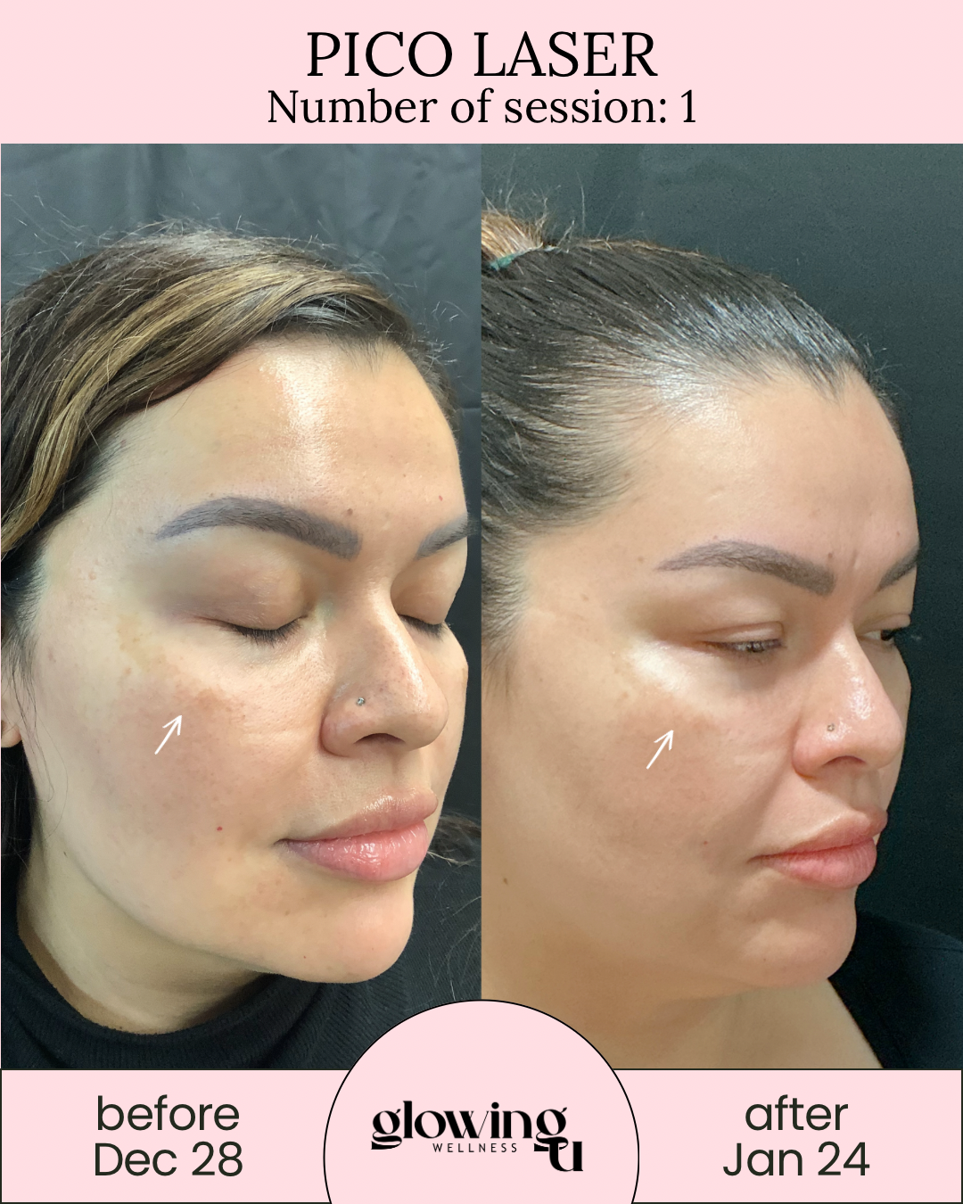 Side-by-side comparison of a woman's face before and after Pico Laser treatment, showing skin improvement. The left side shows her eyes closed and skin with dark spots, labeled 'before Dec 28.' The right side shows her eyes partially open with clearer skin, labeled 'after Jan 24.' The background is black and pink with the text 'Pico Laser' and session number 1.