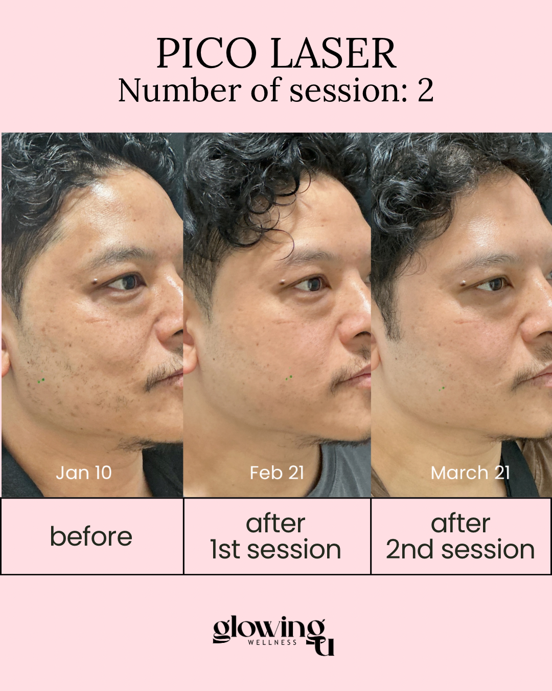 Progress photos of a man's face showing before and after two Pico Laser sessions, dated January 10, February 21, and March 21, illustrating skin improvement.