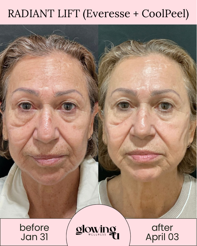Side-by-side comparison photo showing a woman before and after a skincare treatment. The left side labeled 'before Jan 31' has more visible wrinkles and puffiness around the eyes. The right side labeled 'after April 03' shows smoother skin with reduced puffiness, indicating improvements from the treatment.