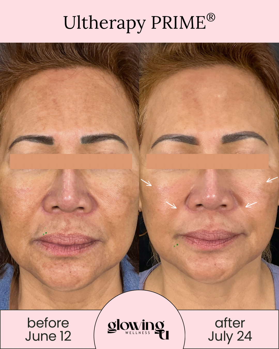 Side-by-side comparison of a woman's face before and after Ultherapy Prime treatment. The left shows her face on June 12 with visible skin imperfections, and the right shows her face on July 24 with reduced skin sagging and improved skin texture.