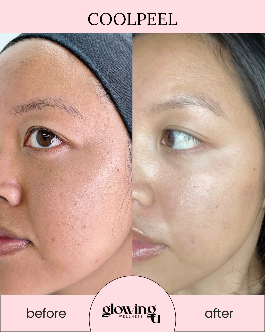 Side-by-side comparison of a woman's face showing clear skin before and after a skincare treatment, with the words 'before' and 'after' and the brand name 'COOLPEEL' at the top.
