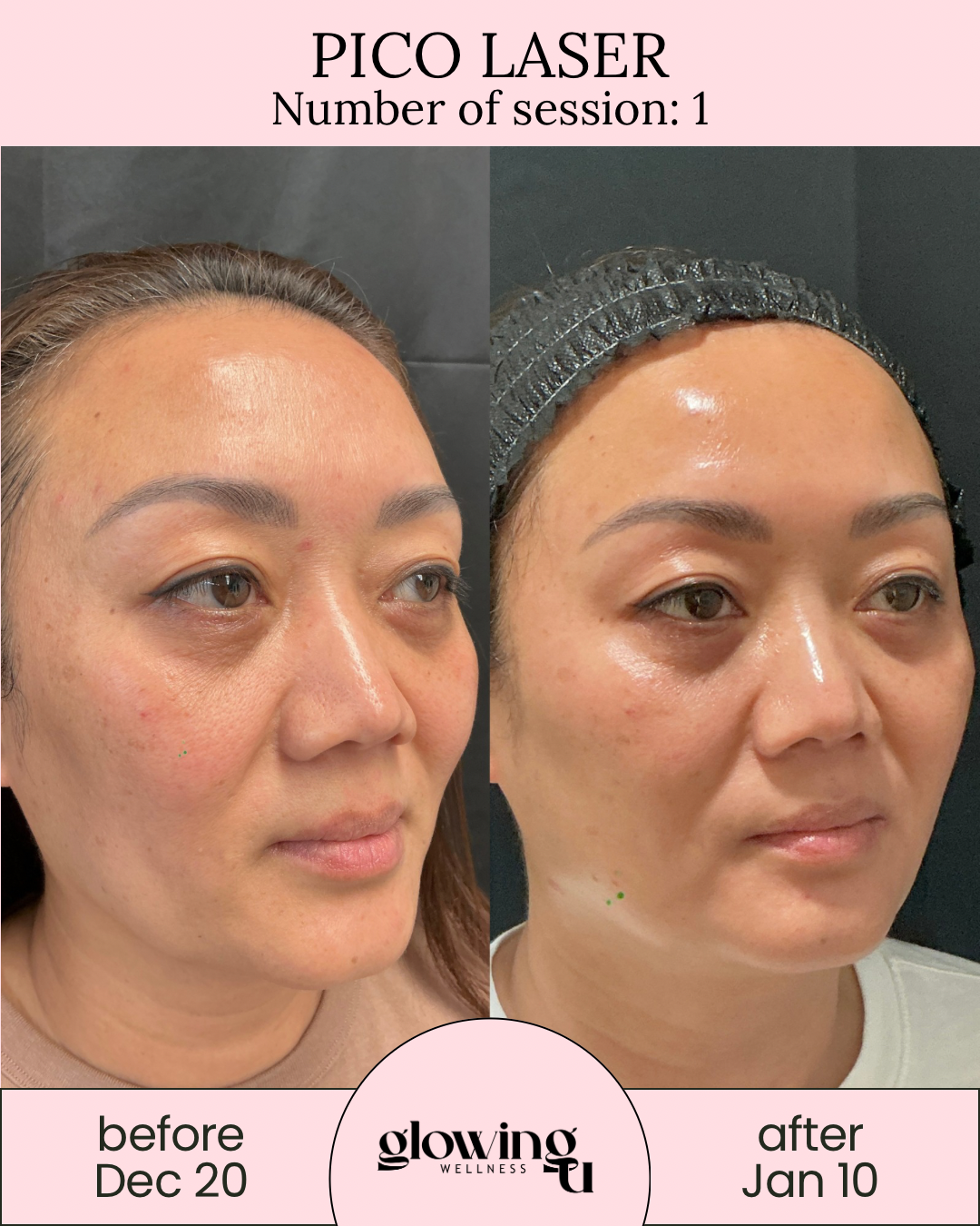 Side-by-side photos showing the face of a woman before and after a laser treatment, with a pink top banner indicating 'PICO LASER' and session number 1. The left photo marked 'before Dec 20' and the right photo marked 'after Jan 10', with a 'glowing wellness' logo at the bottom center.
