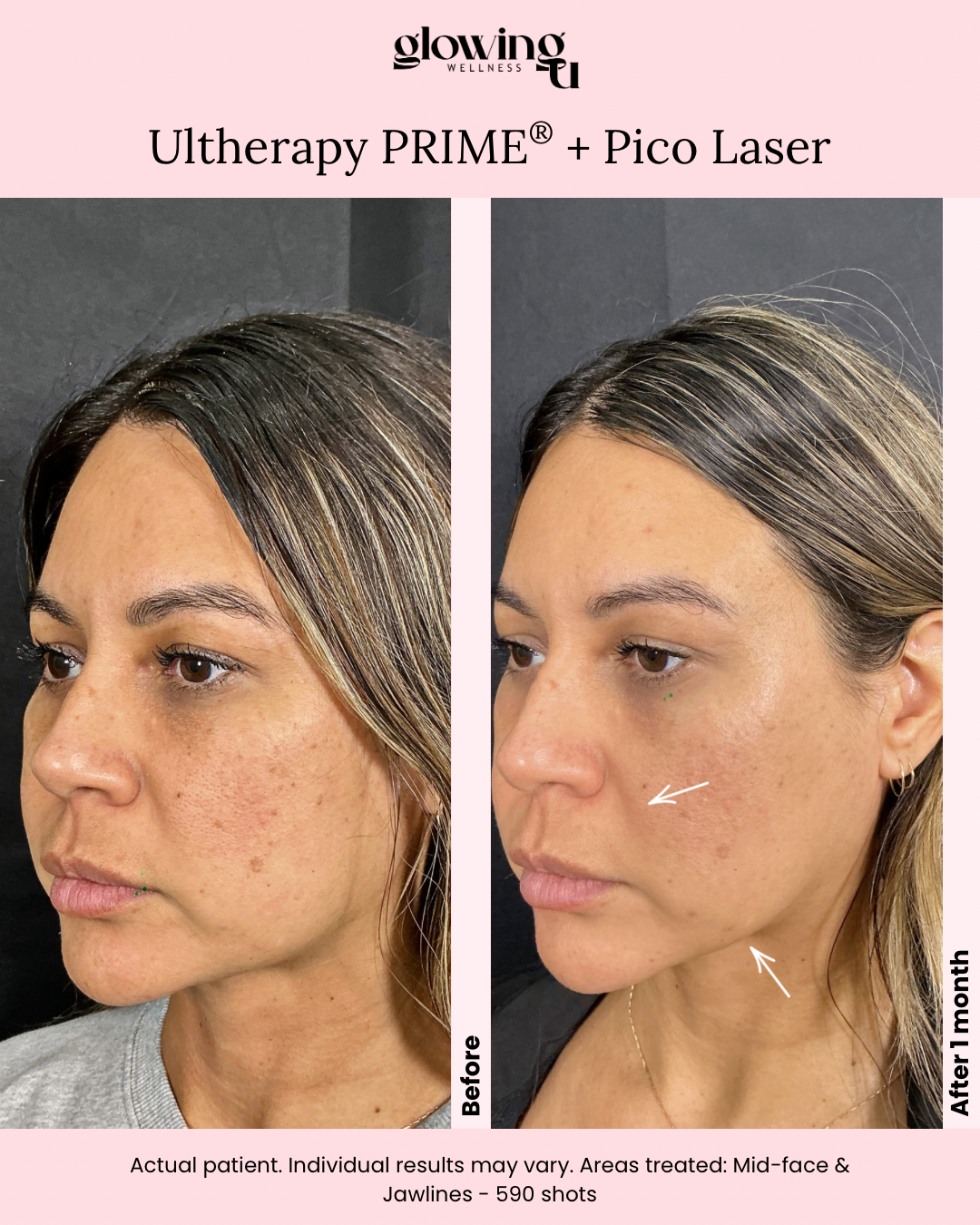 Before and after photos of a woman showing skin improvement, labeled 'Glow Wellness Ultherapy PRIME + Pico Laser' with a pink background. The before photo shows skin with pigmentation and uneven texture; the after photo shows clearer skin with fewer spots. The text indicates a one-month follow-up after 590 treated shots.
