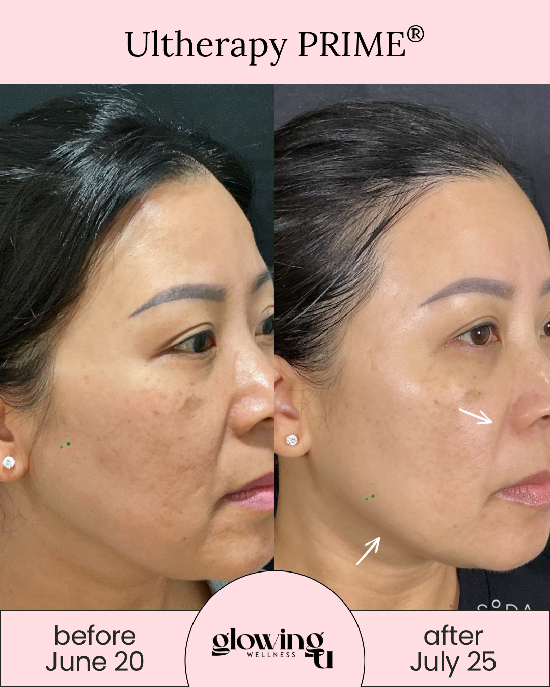 Side-by-side comparison of a woman's face before and after skincare treatment, showing improvements in skin texture and pigmentation, with dates June 20 and July 25.
