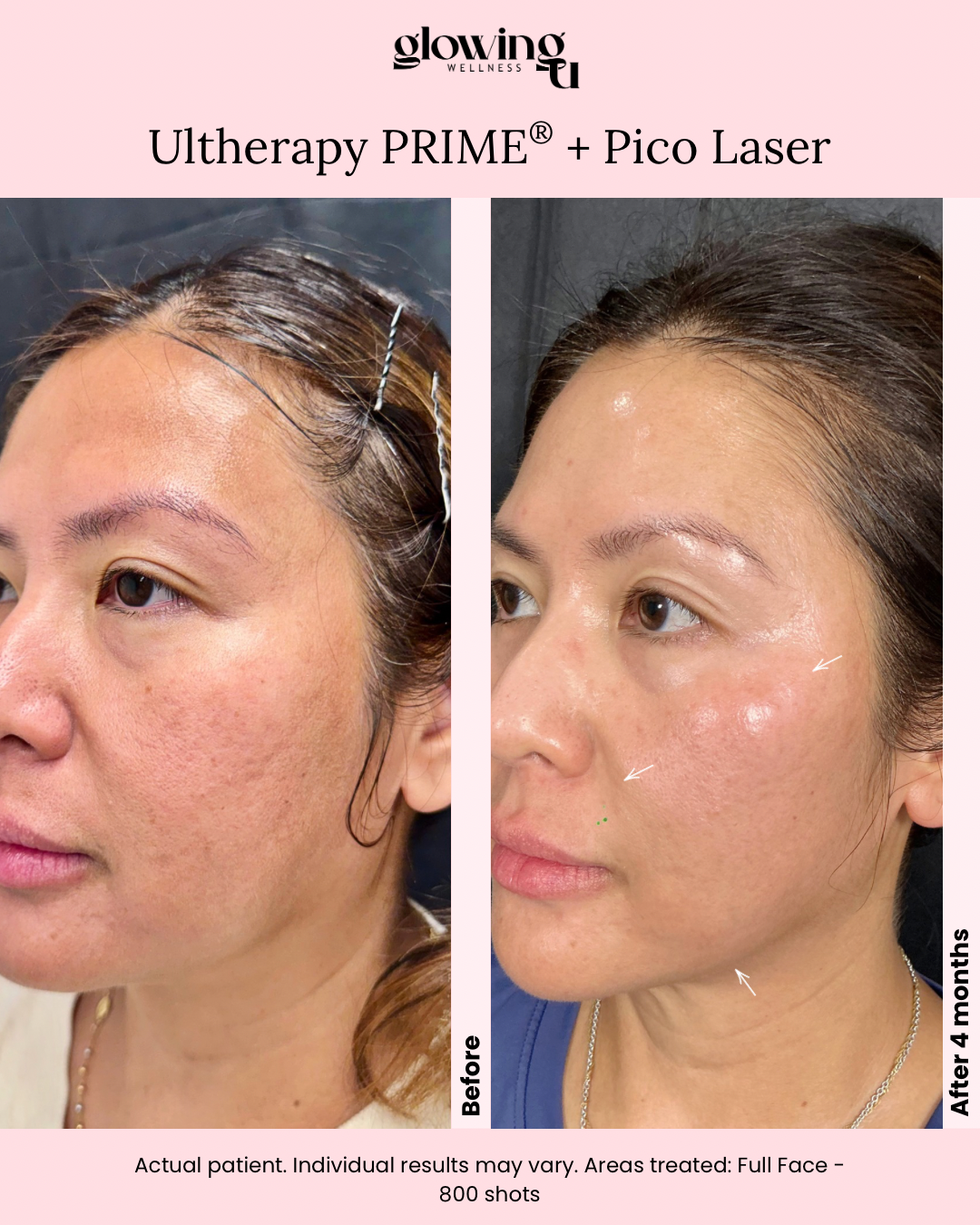 Before and after images showing skin improvement of a woman's face following UV Therapy PRIME and Pico Laser treatment, four months apart, with text indicating the treatment was for full face, 800 shots.