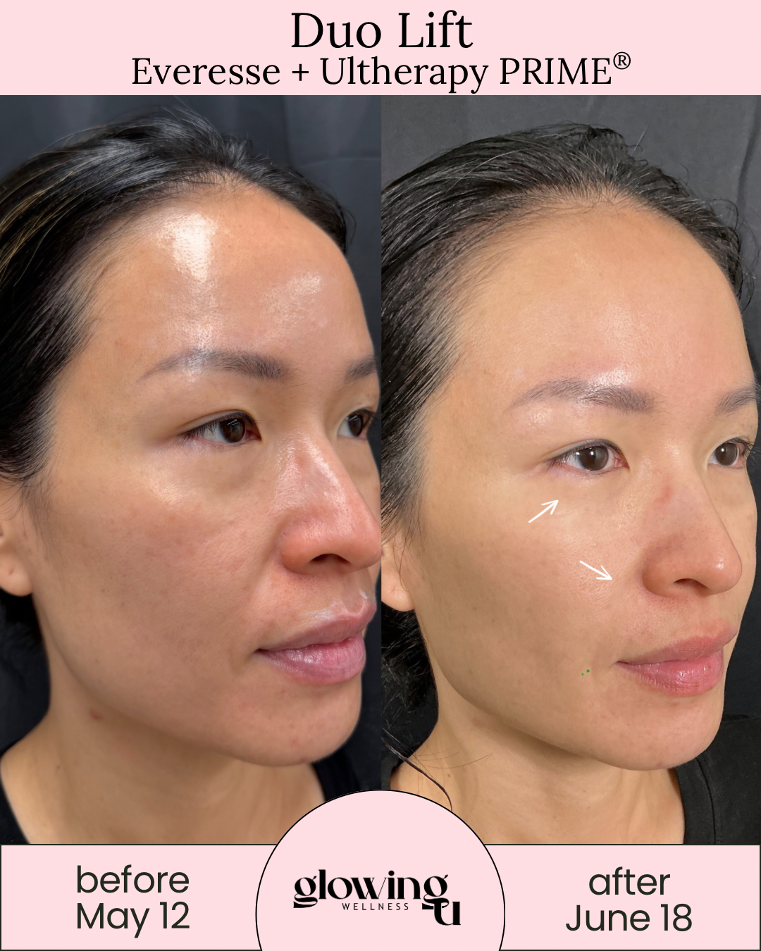 Side-by-side comparison of a woman's face showing skin improvements before May 12 and after June 18, highlighting treatment results from Duo Lift, Everesse, and Ultherapy PRIME at Glow Wellness.