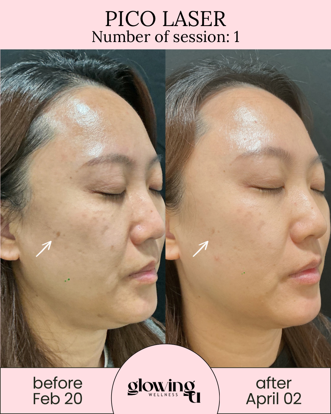 Side-by-side comparison of a woman's face before and after Pico Laser treatment, showing reduced skin imperfections and improved skin texture, with dates February 20 and April 2 noted at the bottom.