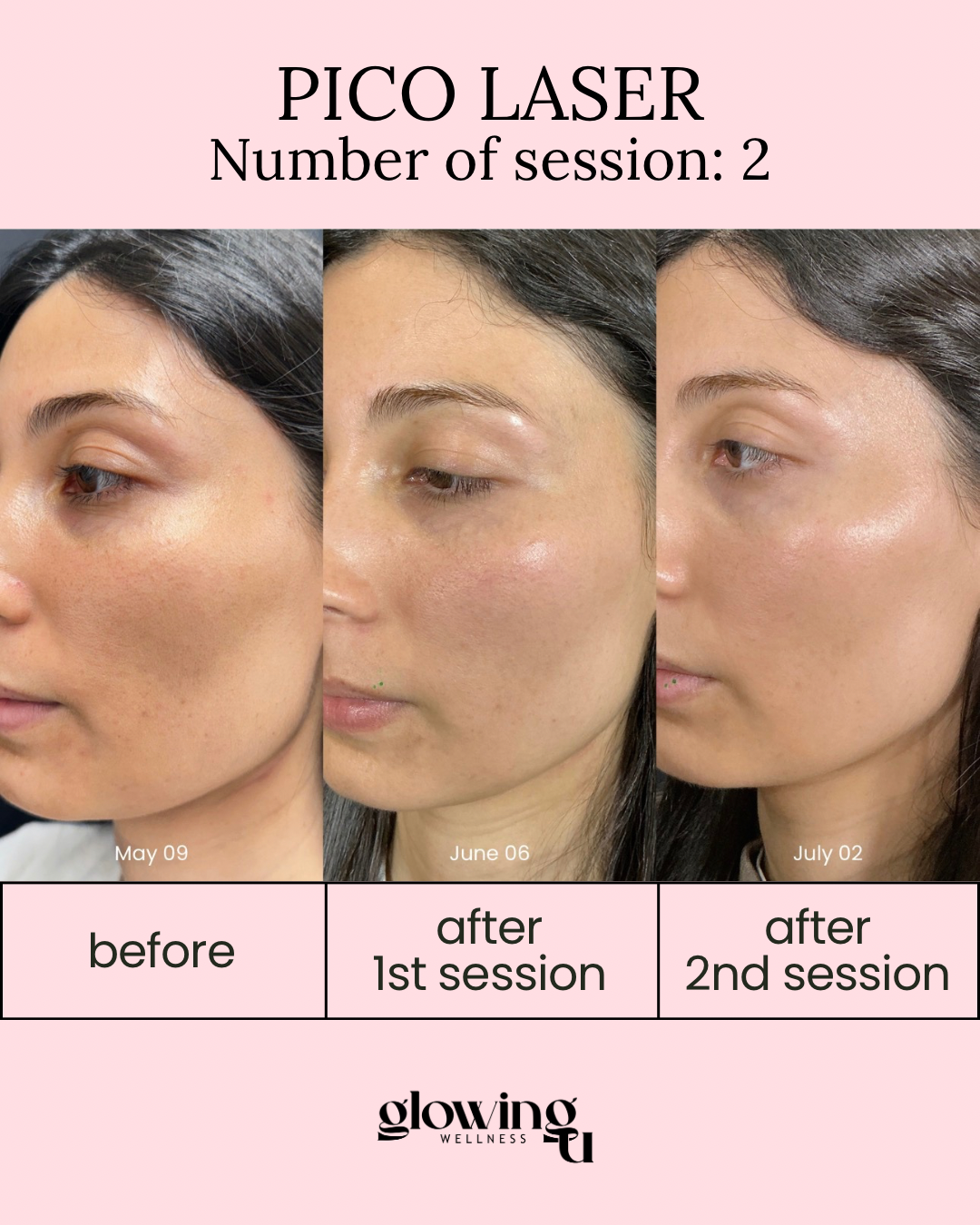 Comparison of a woman's face before and after Pico Laser treatments. The first image is from May 09 showing skin with freckles and uneven tone. The second image is from June 06 showing improved skin texture and reduced freckles after the first session. The third image is from July 02 showing further skin improvement and glow after the second session. The text indicates the treatment session number and the wellness center name, Glowing Wellness.
