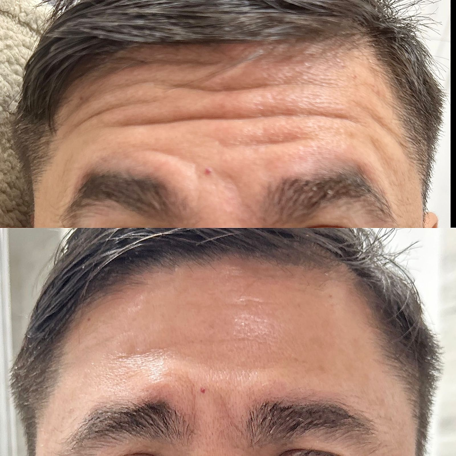Comparison of a person's forehead before and after skincare or treatment, showing reduced wrinkles and improved skin texture.