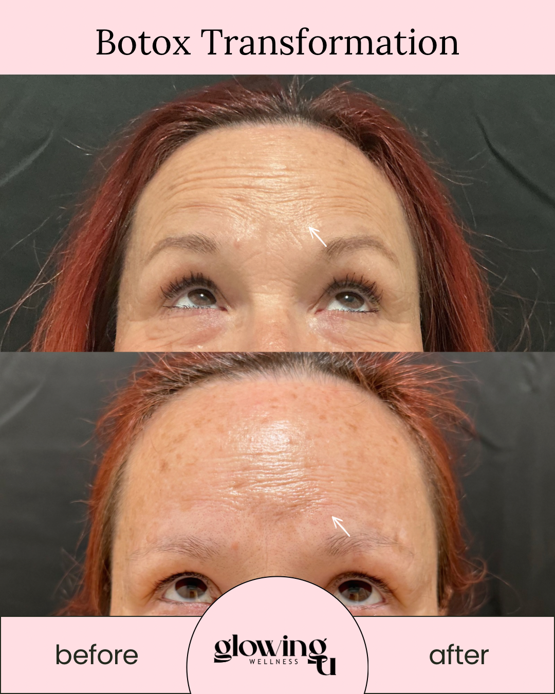 Comparison photo of a woman's forehead before and after Botox treatment, showing reduced wrinkle appearance. The top image shows wrinkles on the forehead, while the bottom image shows smoother skin.