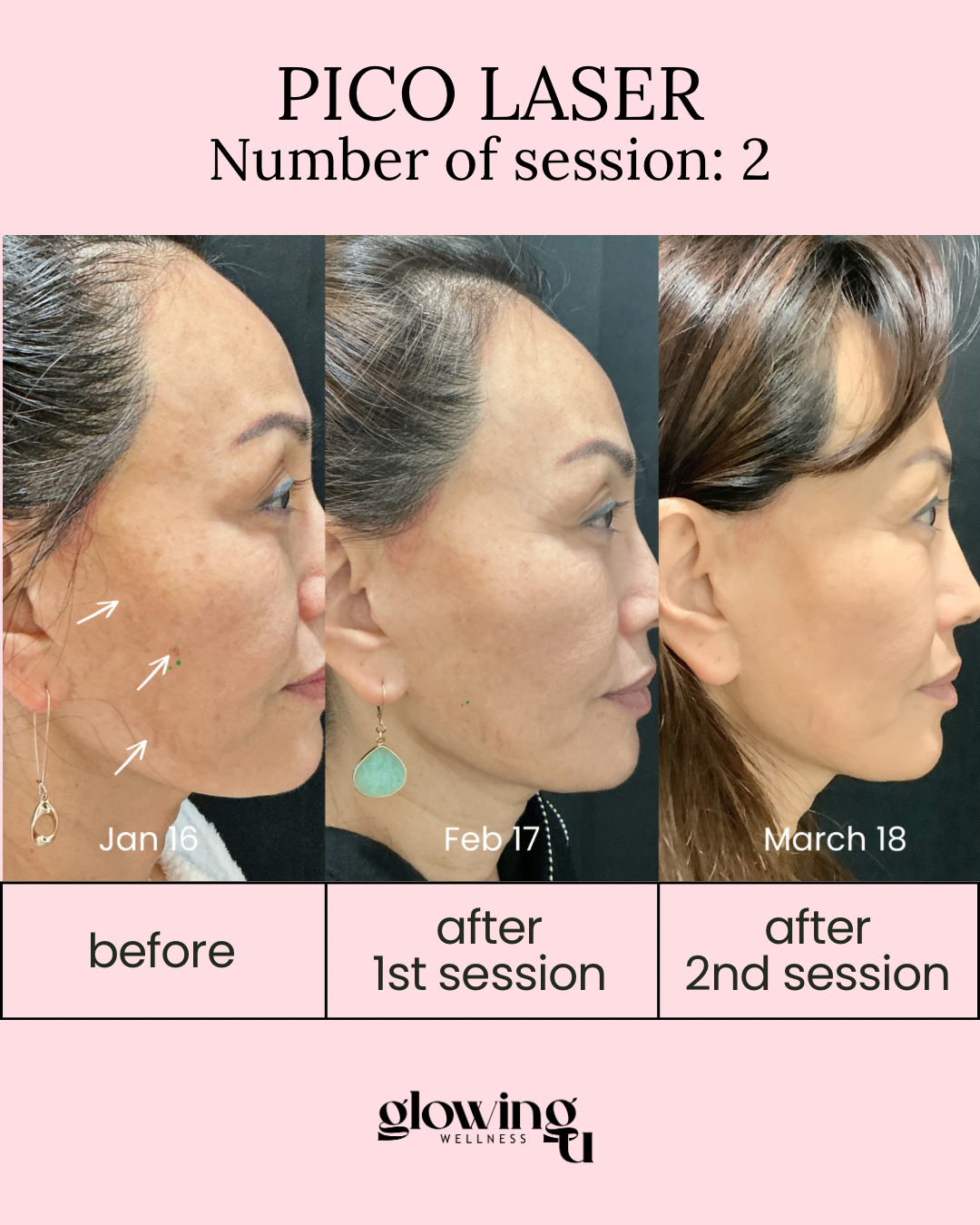 Sequence of three side-profile photos showing skin improvement over time. The first photo is from January 16, marked as before. The second is from February 17, after the first session. The third is from March 18, after the second session, with visibly smoother skin. Text indicates progress with the Pico Laser treatment, noting session number 2, and the brand Glowing Wellness.